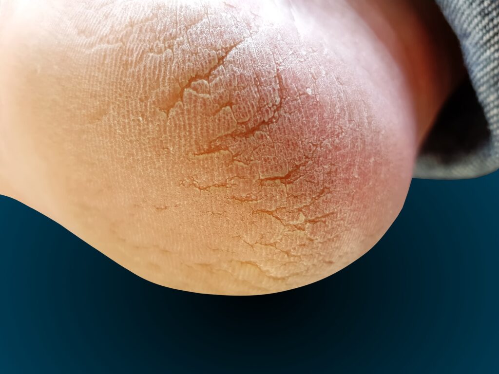 Close-up of a cracked heel