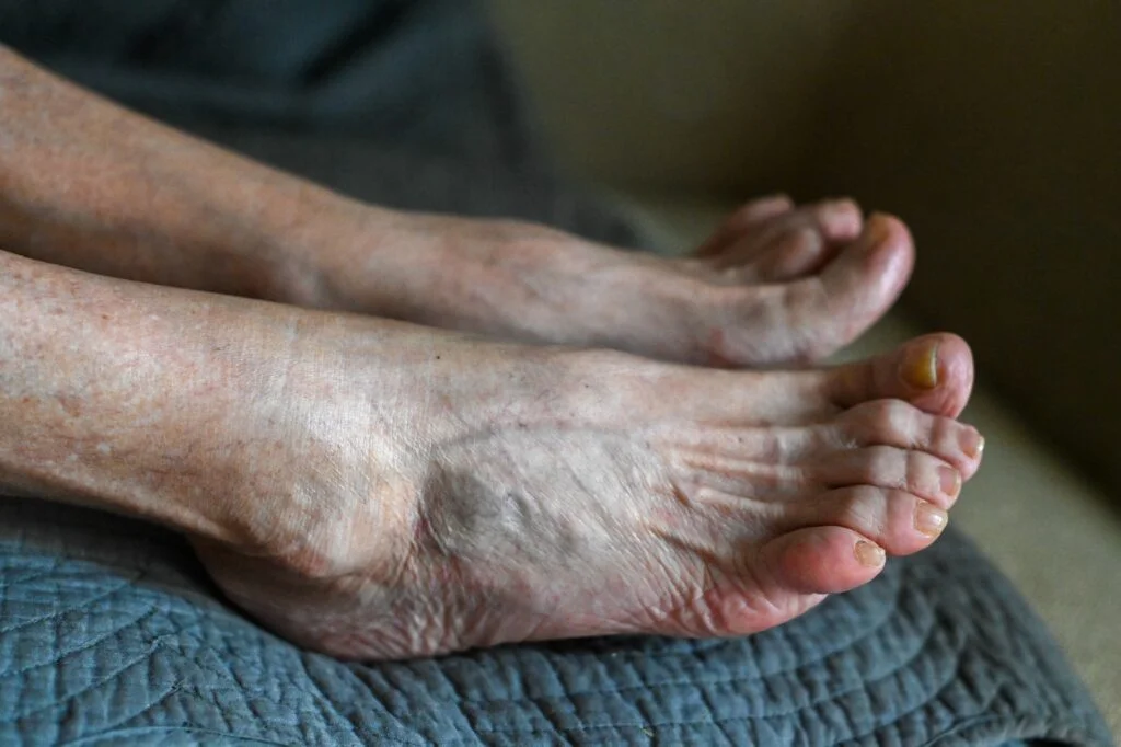 Close-up of swollen feet and ankles.